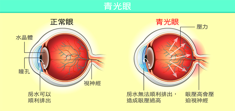 青光眼