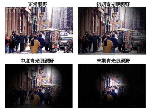 青光眼症状(病征)有哪些?